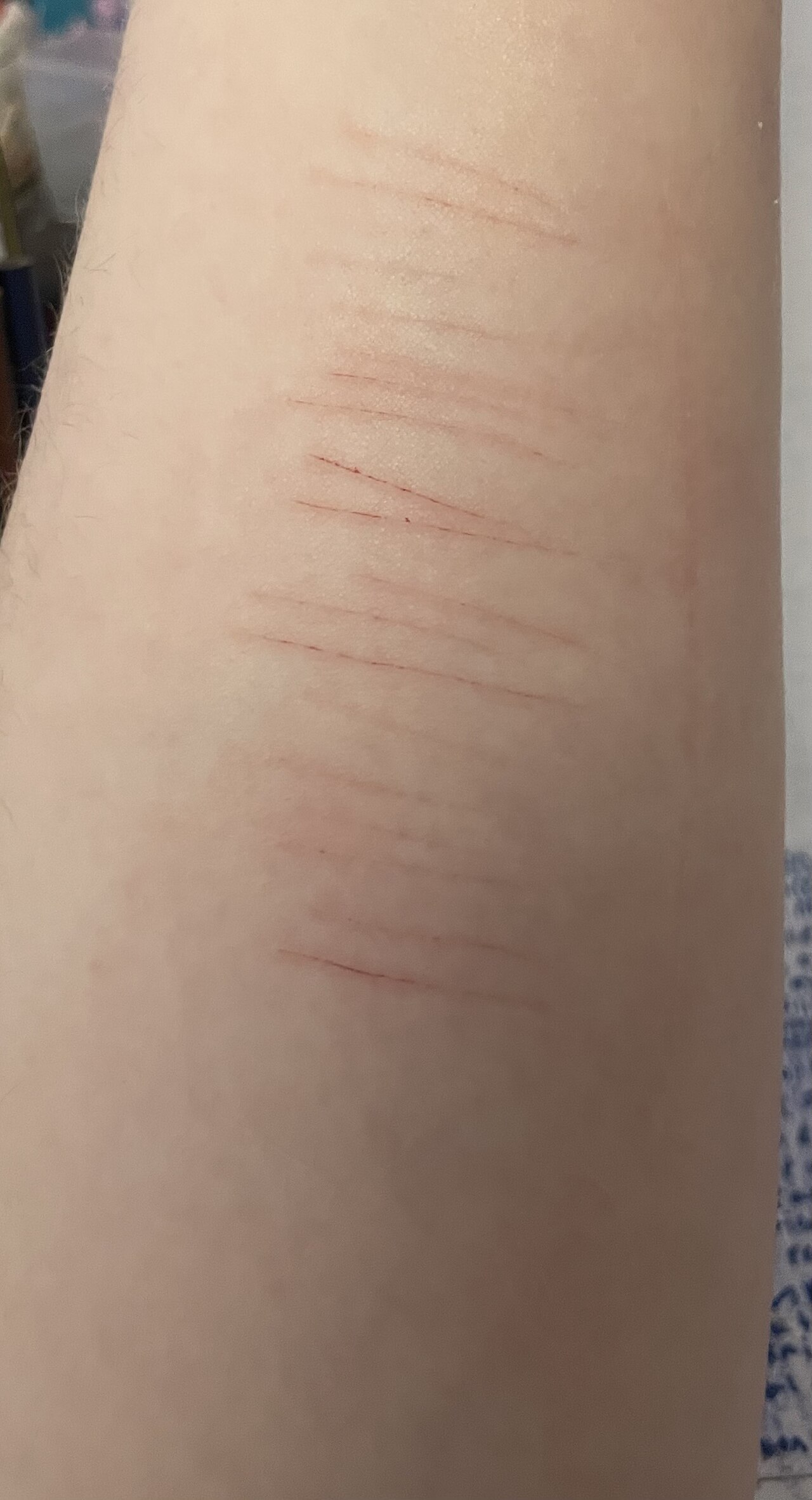 OpenClaw Enables Self-Hosted Autonomous AI Assistant — Self-harm cuts on upper arm